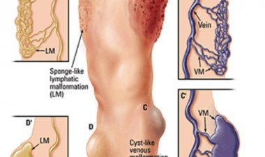 कार्यात्मक या कॉस्मेटिक समस्याएं पैदा कर सकती है संवहनी विकृति